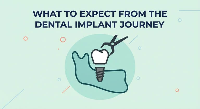 What to Expect From the Dental Implant Journey
